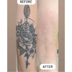 Bonsai Laser Tattoo Removal — Tattoo removal service in Frisco